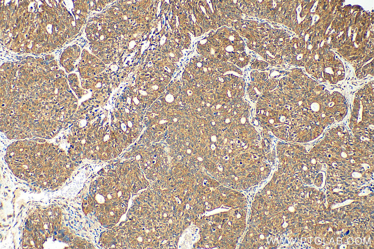 IHC staining of human ovary tumor using 17914-1-AP