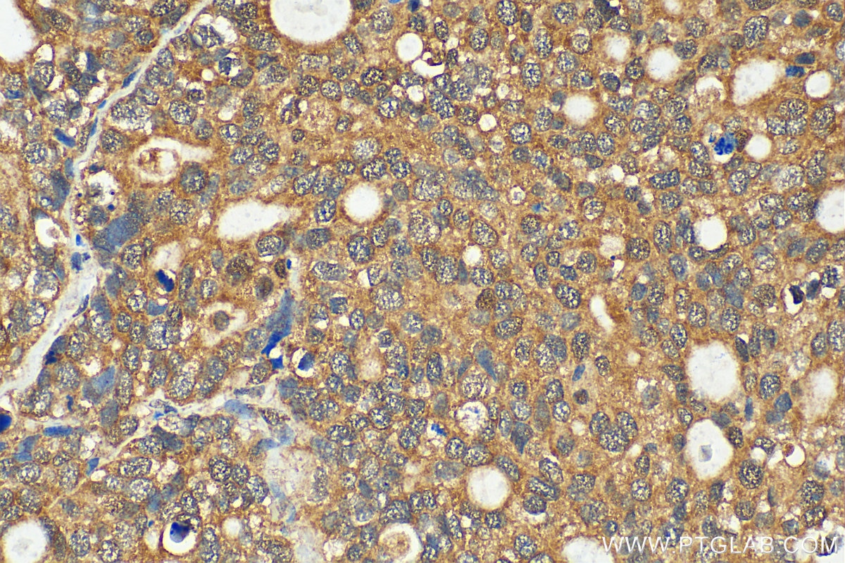 Immunohistochemistry (IHC) staining of human ovary tumor tissue using MDMX Polyclonal antibody (17914-1-AP)