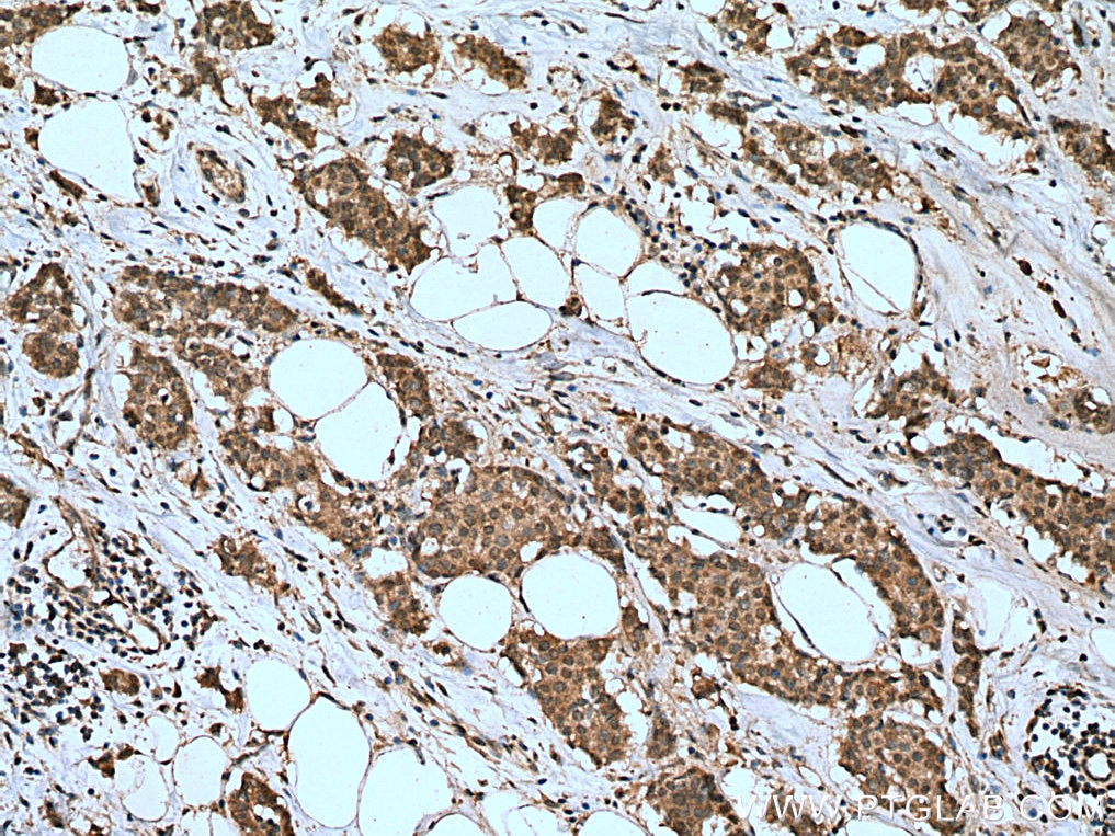 Immunohistochemistry (IHC) staining of human breast cancer tissue using MDMX Polyclonal antibody (28747-1-AP)