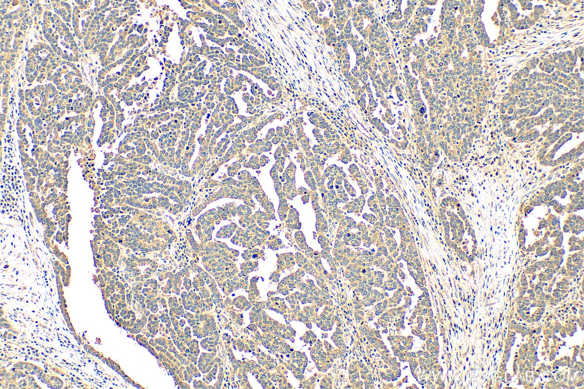 Immunohistochemistry (IHC) staining of human ovary tumor tissue using MDMX Polyclonal antibody (28747-1-AP)