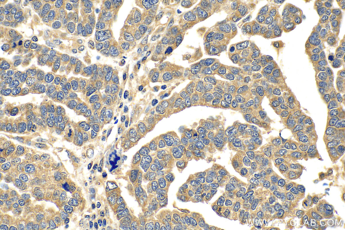 Immunohistochemistry (IHC) staining of human ovary tumor tissue using MDMX Polyclonal antibody (28747-1-AP)