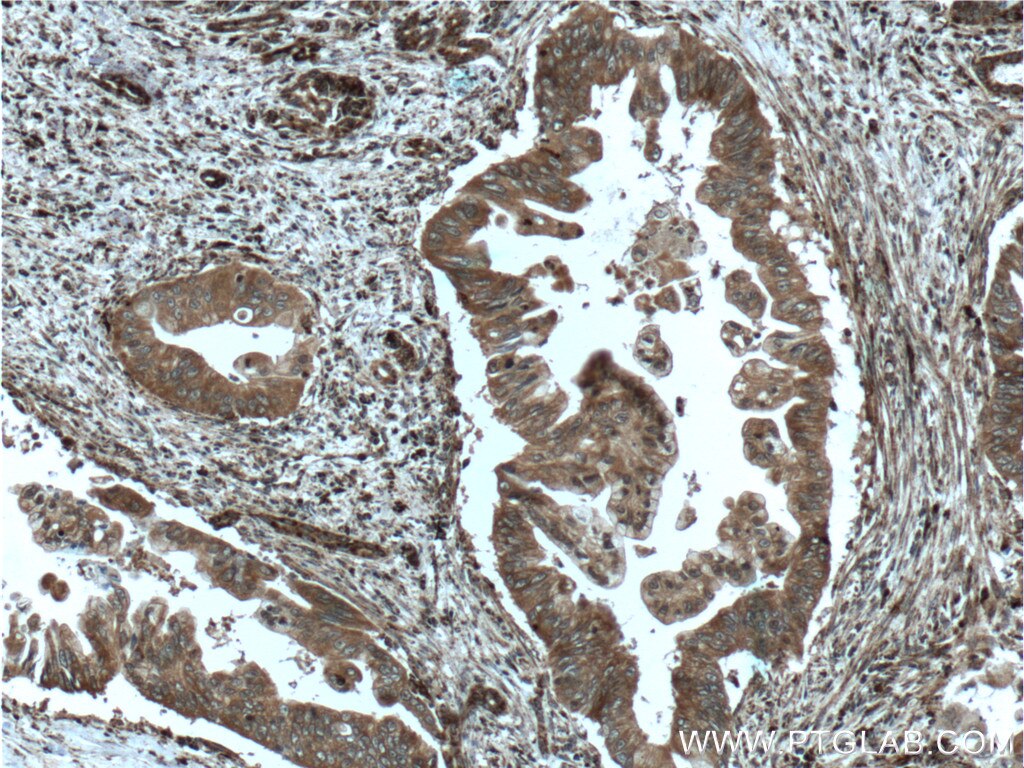 Immunohistochemistry (IHC) staining of human pancreas cancer tissue using ME2 Polyclonal antibody (24944-1-AP)