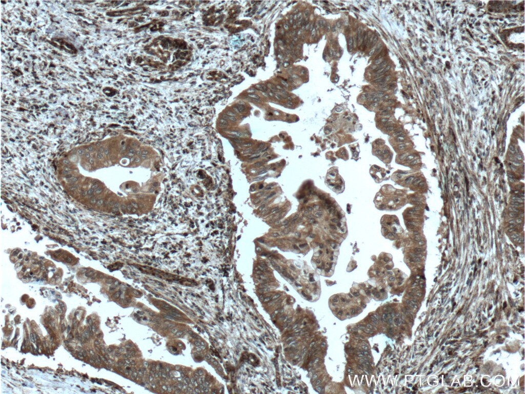 IHC staining of human pancreas cancer using 24944-1-AP