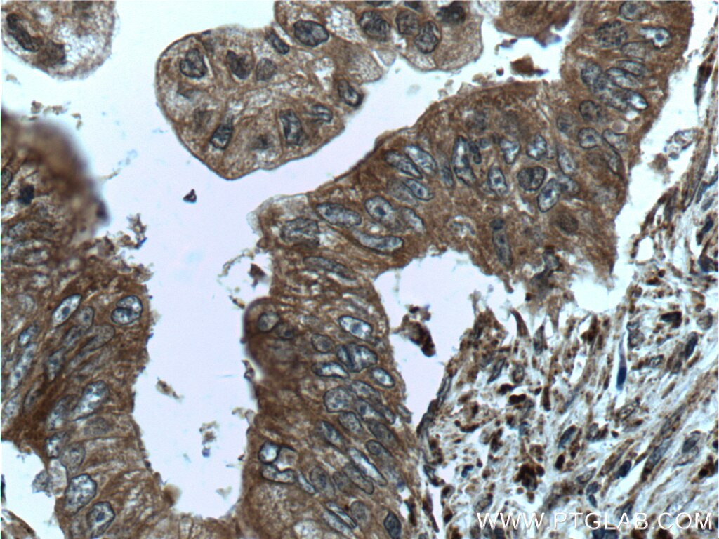 IHC staining of human pancreas cancer using 24944-1-AP