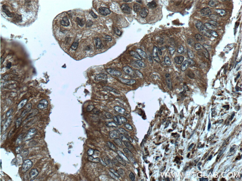 Immunohistochemistry (IHC) staining of human pancreas cancer tissue using ME2 Polyclonal antibody (24944-1-AP)