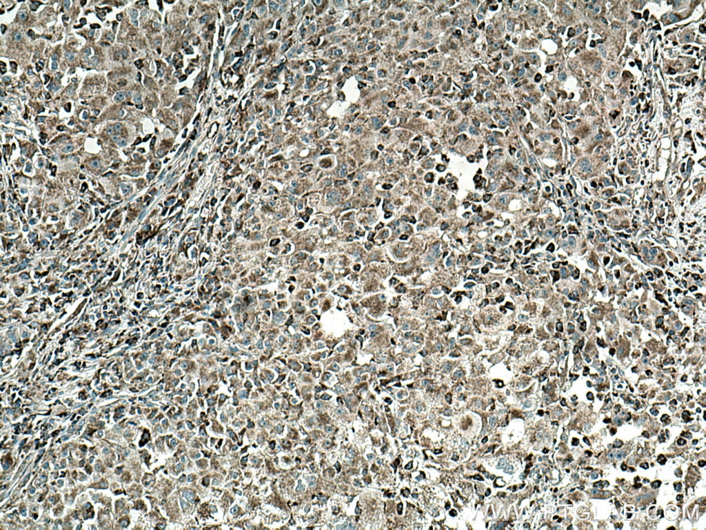 Immunohistochemistry (IHC) staining of human liver cancer tissue using ME2 Monoclonal antibody (67457-1-Ig)