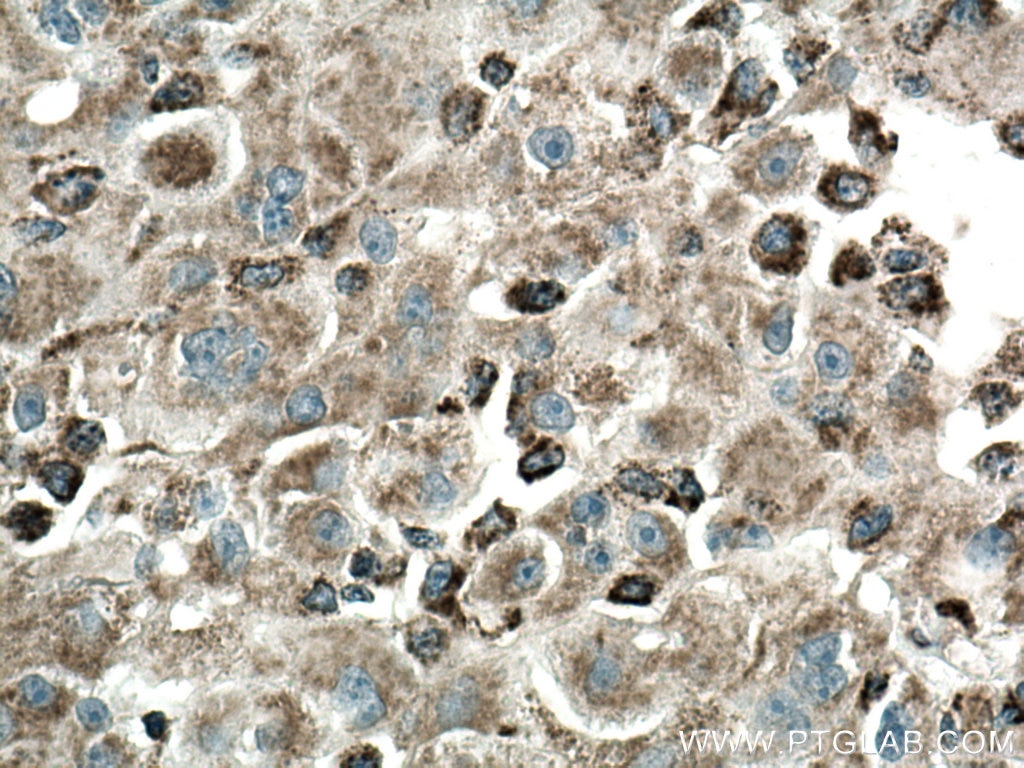 Immunohistochemistry (IHC) staining of human liver cancer tissue using ME2 Monoclonal antibody (67457-1-Ig)