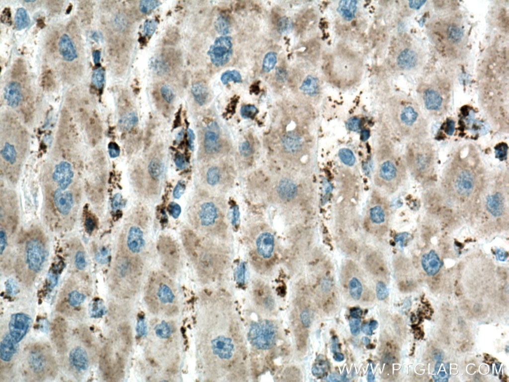 Immunohistochemistry (IHC) staining of human liver cancer tissue using ME2 Monoclonal antibody (67457-1-Ig)