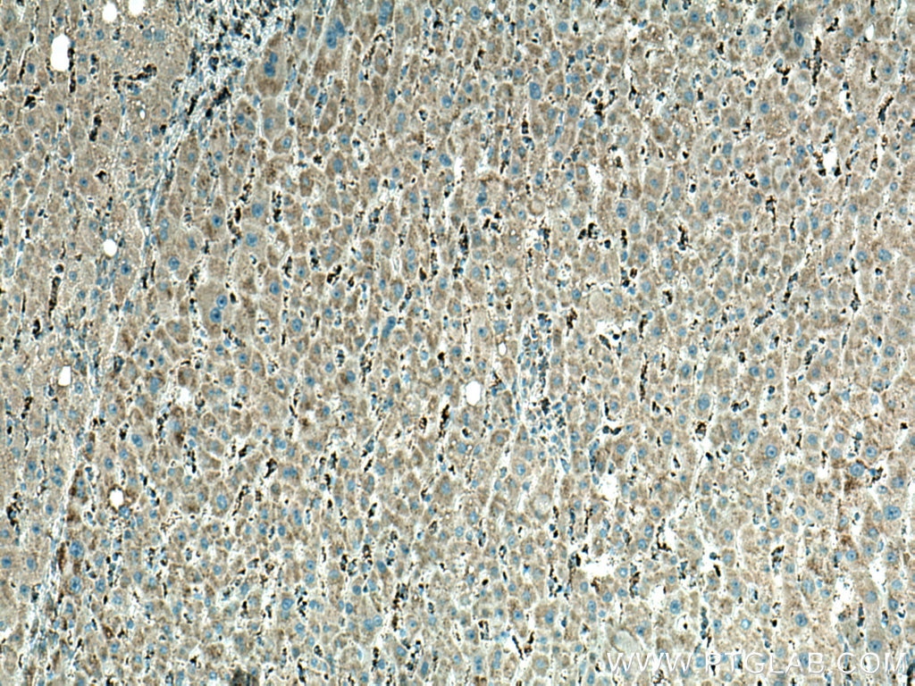 IHC staining of human liver cancer using 67457-1-Ig