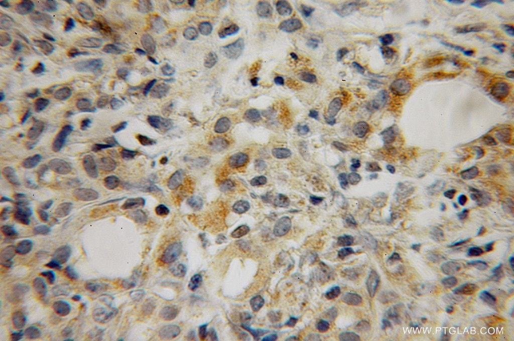 Immunohistochemistry (IHC) staining of human pancreas cancer tissue using MEA1 Polyclonal antibody (10267-1-AP)