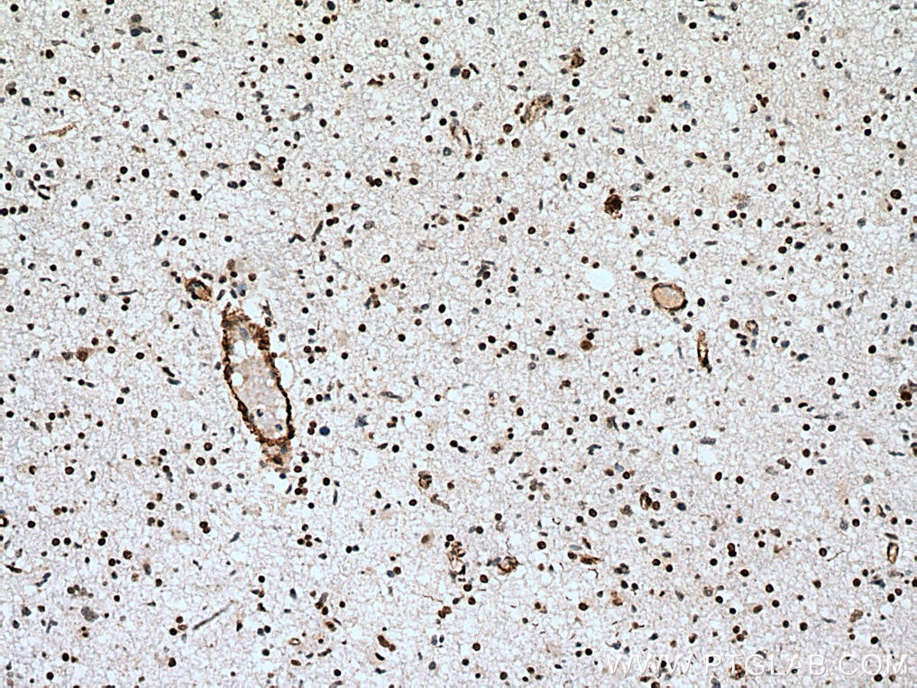 Immunohistochemistry (IHC) staining of human gliomas tissue using MECP2 Polyclonal antibody (10861-1-AP)