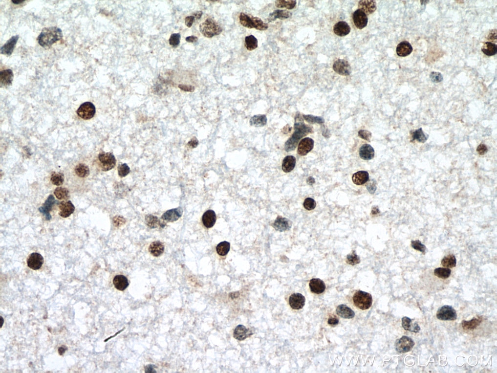 Immunohistochemistry (IHC) staining of human gliomas tissue using MECP2 Polyclonal antibody (10861-1-AP)