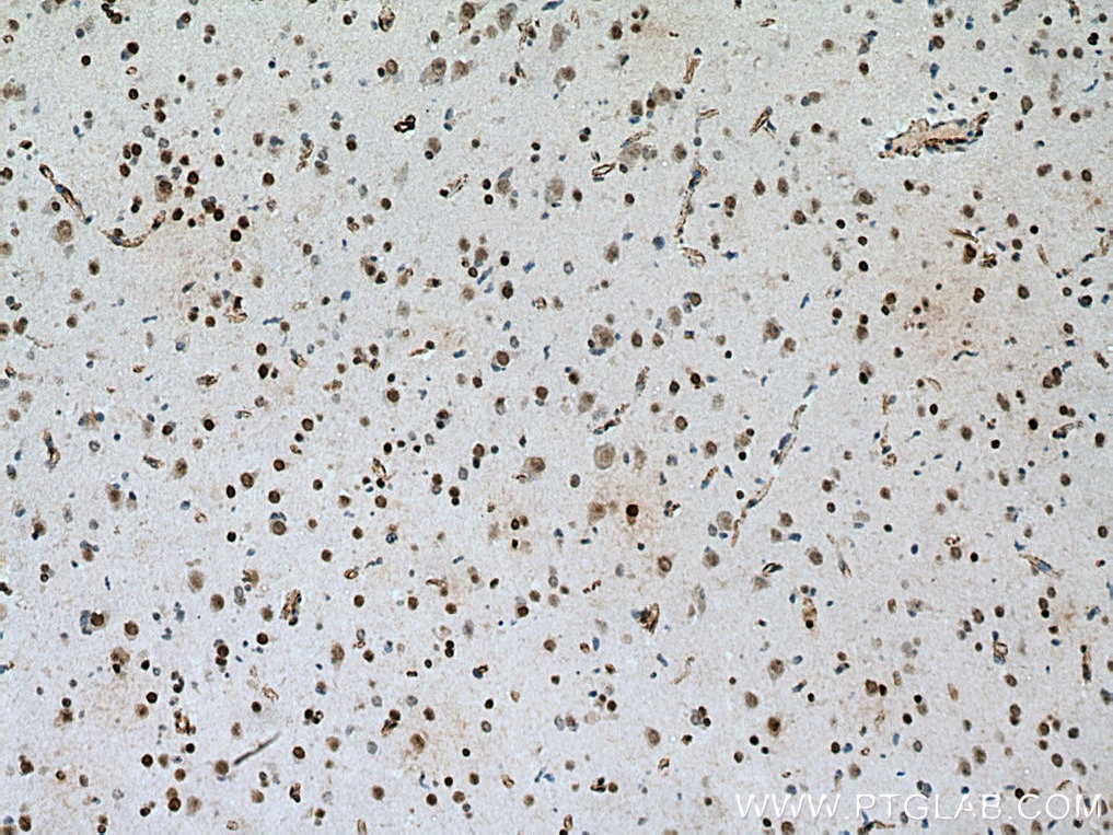 Immunohistochemistry (IHC) staining of human gliomas tissue using MECP2 Polyclonal antibody (10861-1-AP)