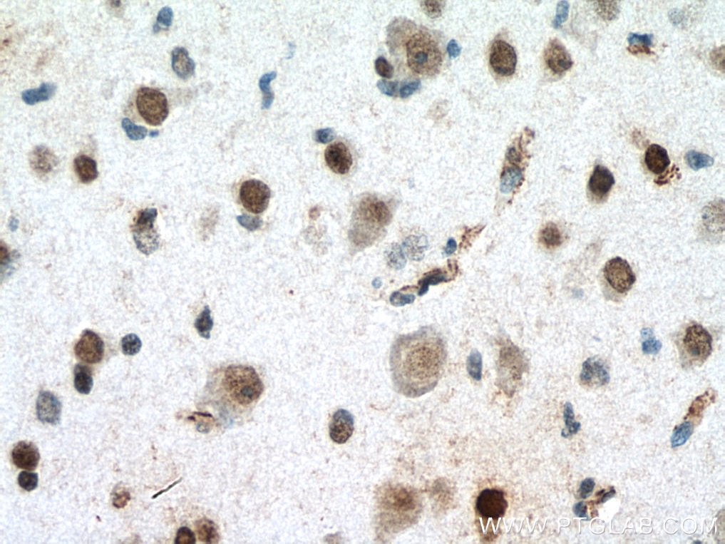 Immunohistochemistry (IHC) staining of human gliomas tissue using MECP2 Polyclonal antibody (10861-1-AP)