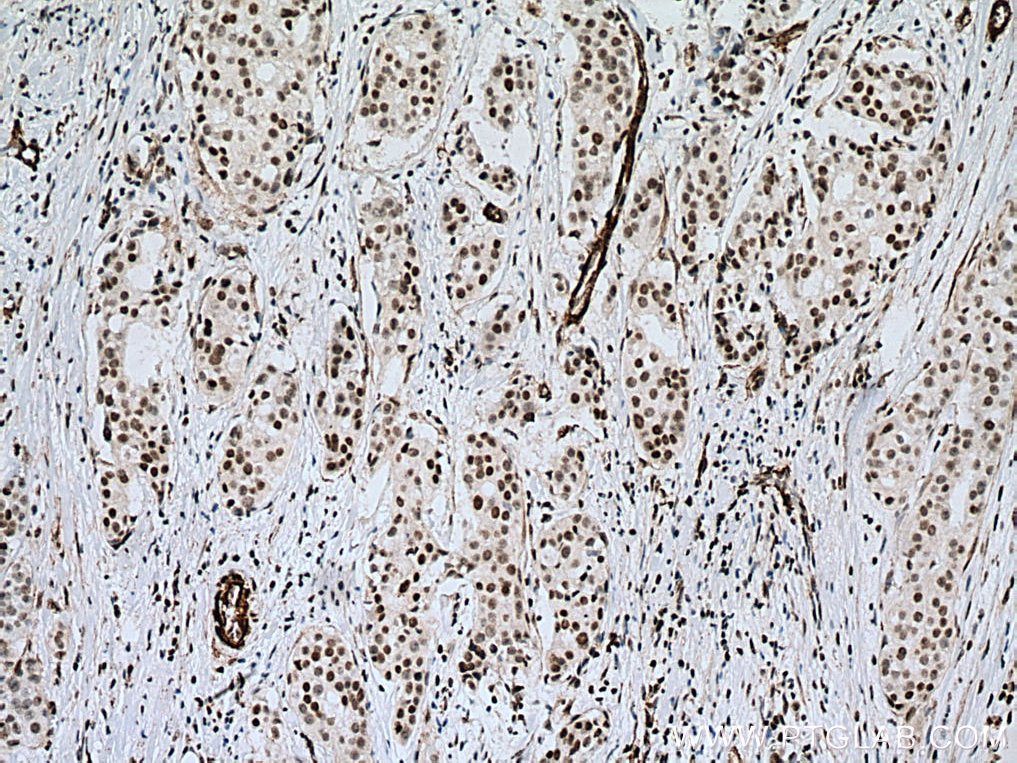 Immunohistochemistry (IHC) staining of human breast cancer tissue using MECP2 Polyclonal antibody (10861-1-AP)