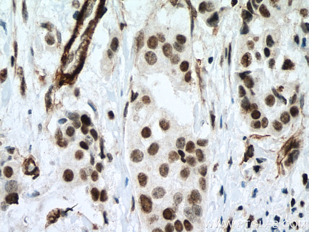 Immunohistochemistry (IHC) staining of human breast cancer tissue using MECP2 Polyclonal antibody (10861-1-AP)