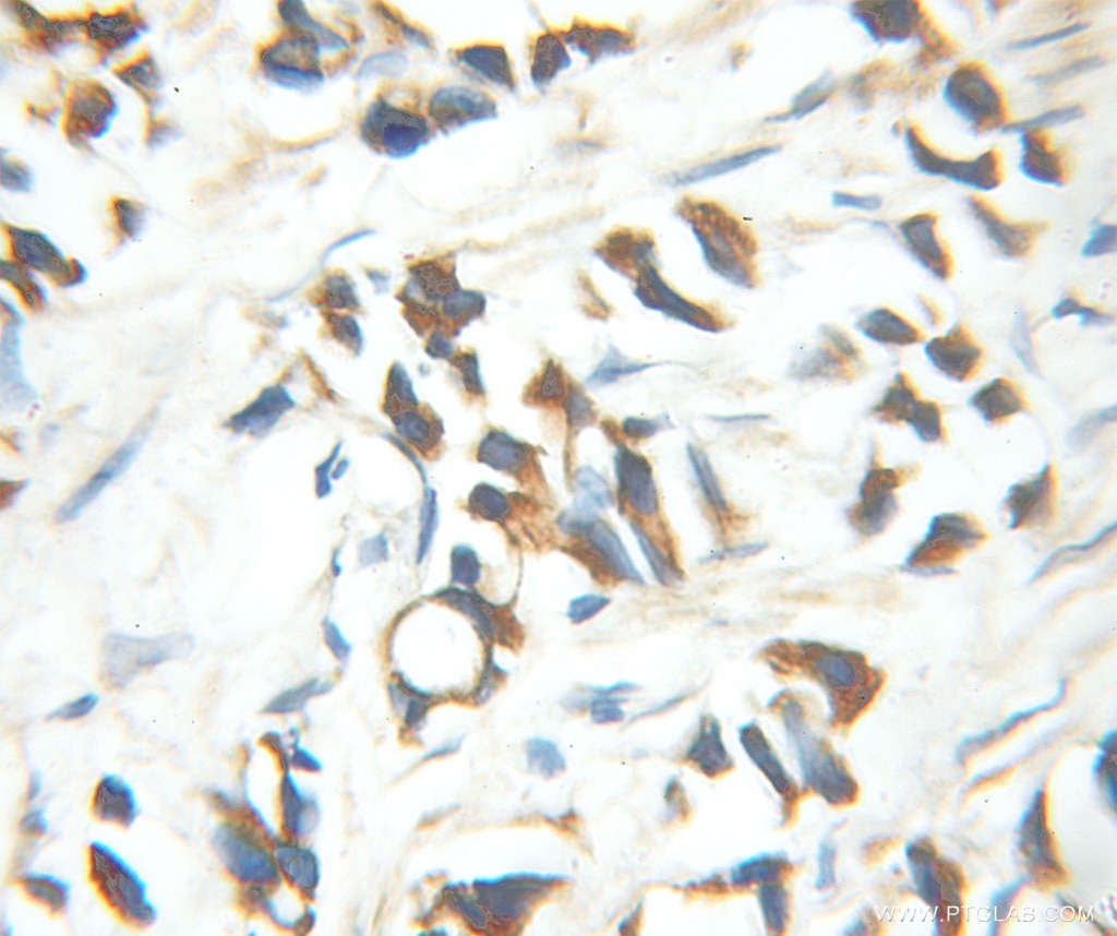 Immunohistochemistry (IHC) staining of human prostate cancer tissue using MED15 Polyclonal antibody (11566-1-AP)