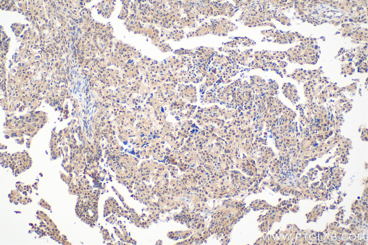 Immunohistochemical analysis of paraffin-embedded human ovary cancer tissue slide using 33366-1-AP (MED29 antibody) at dilution of 1:400 (under 20x lens). Heat mediated antigen retrieval with Tris-EDTA buffer (pH 9.0). Immunohistochemistry (IHC) staining of human ovary cancer tissue using MED29 Polyclonal antibody (33366-1-AP)