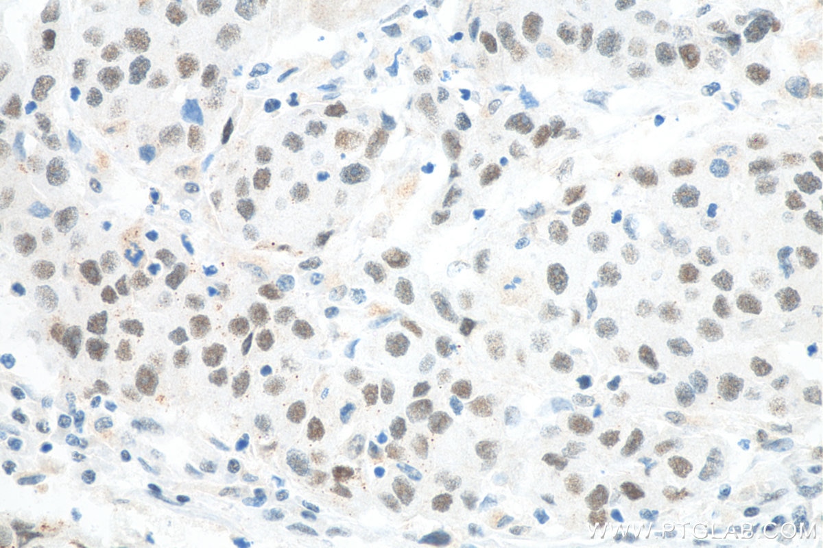 Immunohistochemistry (IHC) staining of human breast cancer tissue using MED4 Monoclonal antibody (67839-1-Ig)