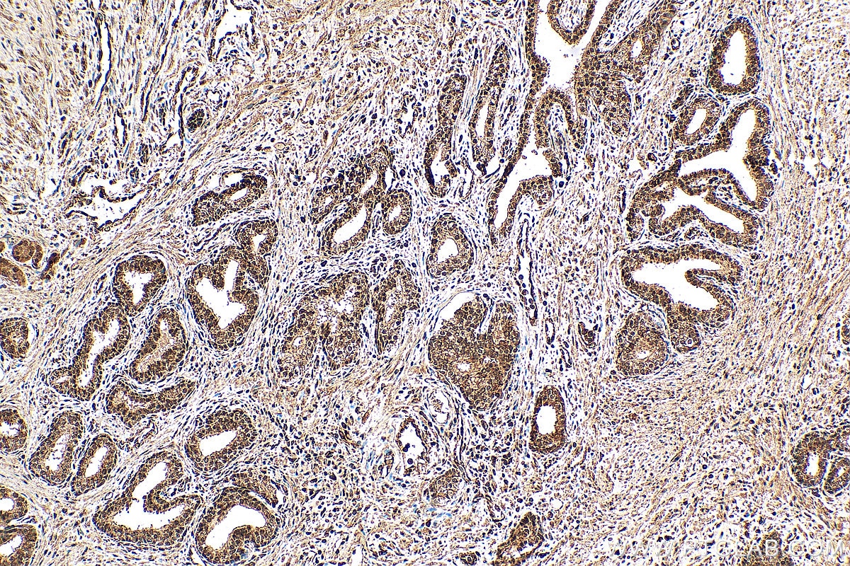 Immunohistochemistry (IHC) staining of human prostate cancer tissue using MED6 Polyclonal antibody (15338-1-AP)
