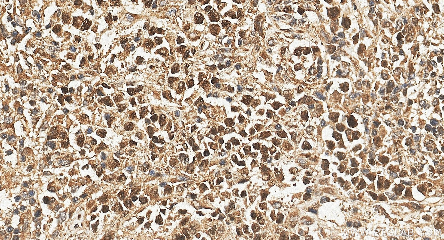 IHC staining of human lymphoma using 10056-1-AP Immunohistochemistry (IHC) staining of human lymphoma tissue using MEF2C Polyclonal antibody (10056-1-AP)