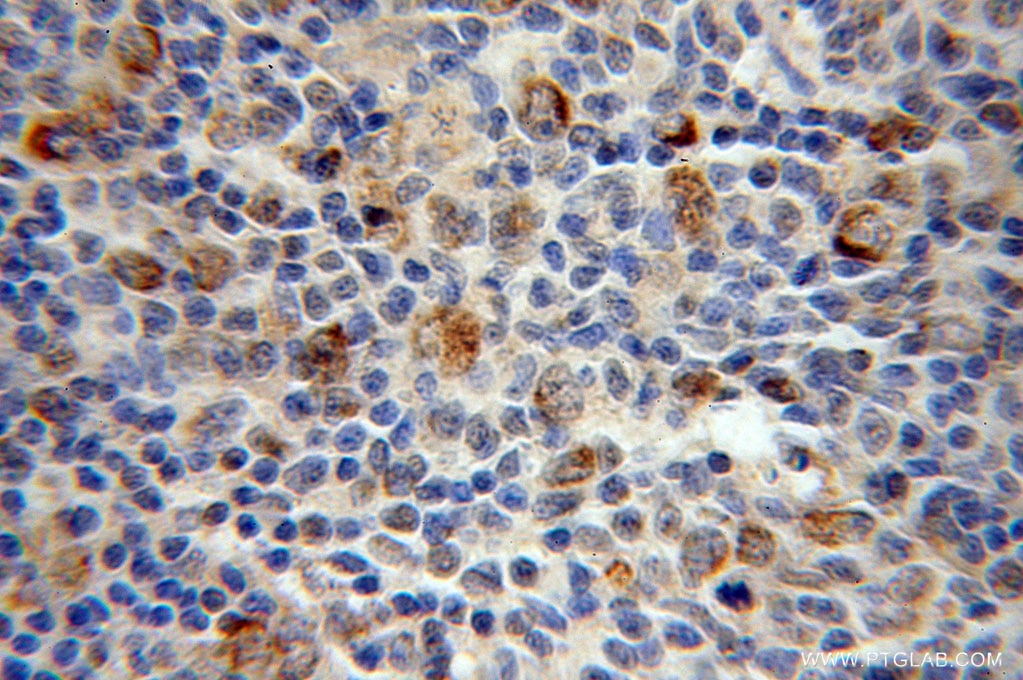 Immunohistochemistry (IHC) staining of human lymphoma tissue using MEF2C Polyclonal antibody (10056-1-AP)