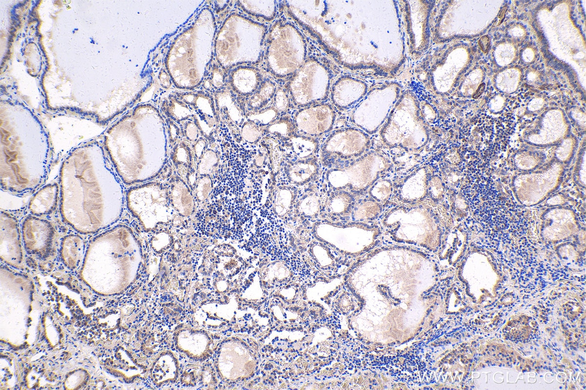 Immunohistochemistry (IHC) staining of human thyroid cancer tissue using MEF2C Polyclonal antibody (20326-1-AP)