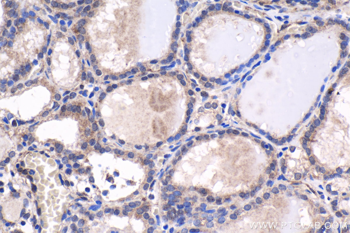 Immunohistochemistry (IHC) staining of human thyroid cancer tissue using MEF2C Polyclonal antibody (20326-1-AP)