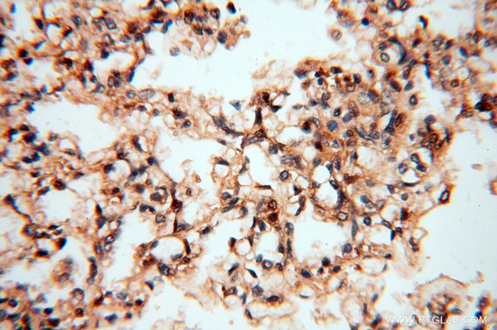 Immunohistochemistry (IHC) staining of human lung tissue using MEF2C-Specific Polyclonal antibody (18293-1-AP)