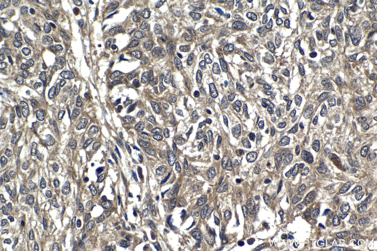 Immunohistochemistry (IHC) staining of human cervical cancer tissue using MEI1 Polyclonal antibody (13456-1-AP)