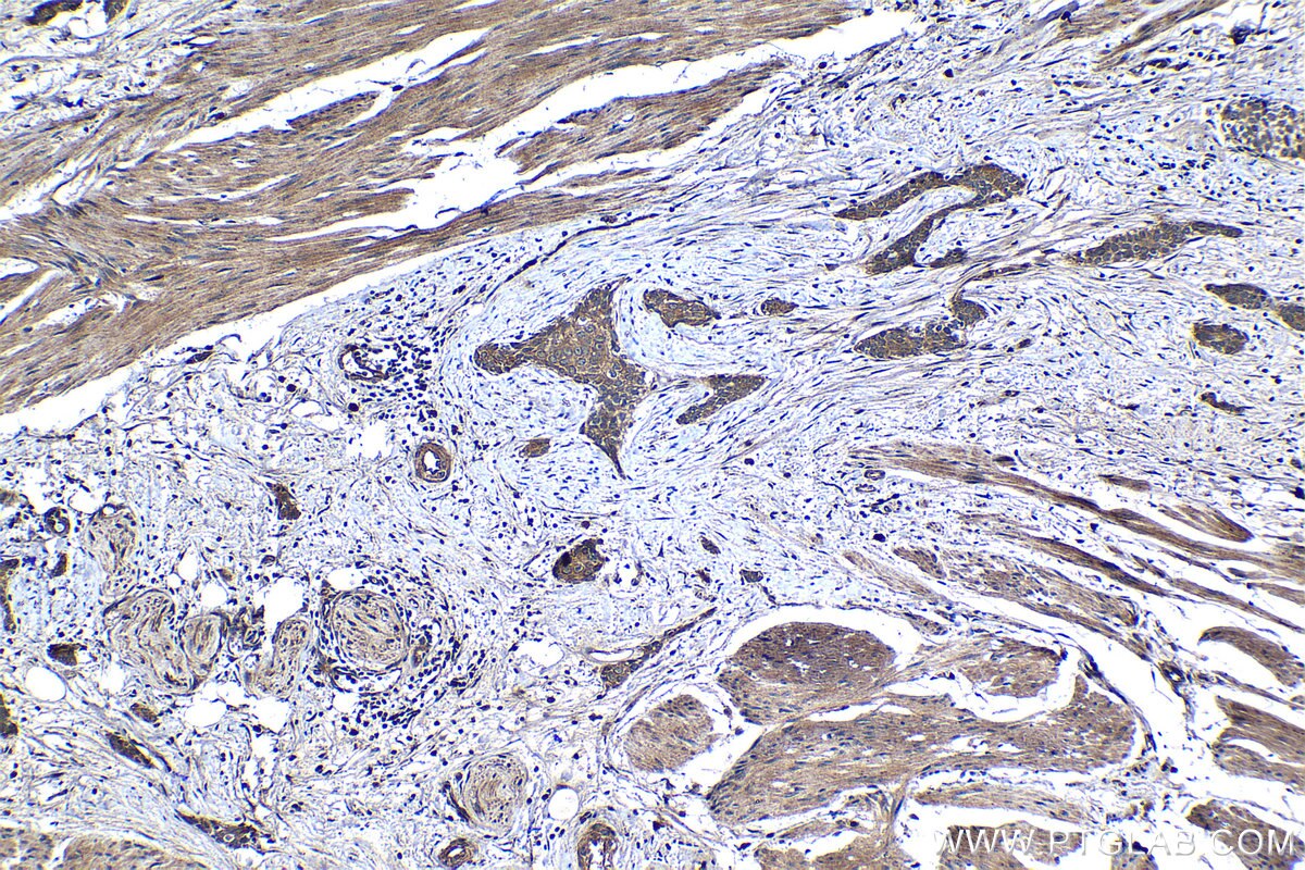 Immunohistochemistry (IHC) staining of human urothelial carcinoma tissue using MEI1 Polyclonal antibody (13456-1-AP)