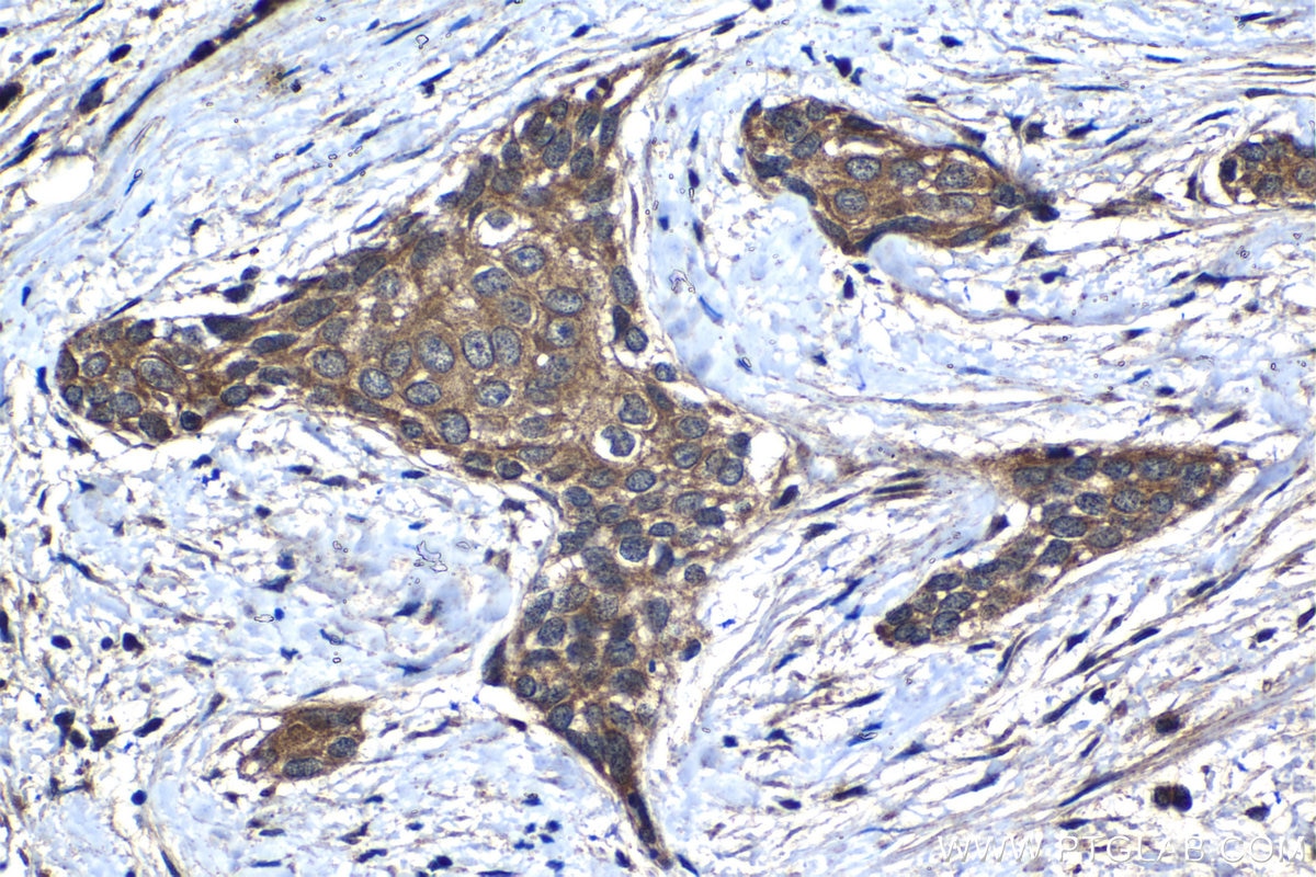 Immunohistochemistry (IHC) staining of human urothelial carcinoma tissue using MEI1 Polyclonal antibody (13456-1-AP)