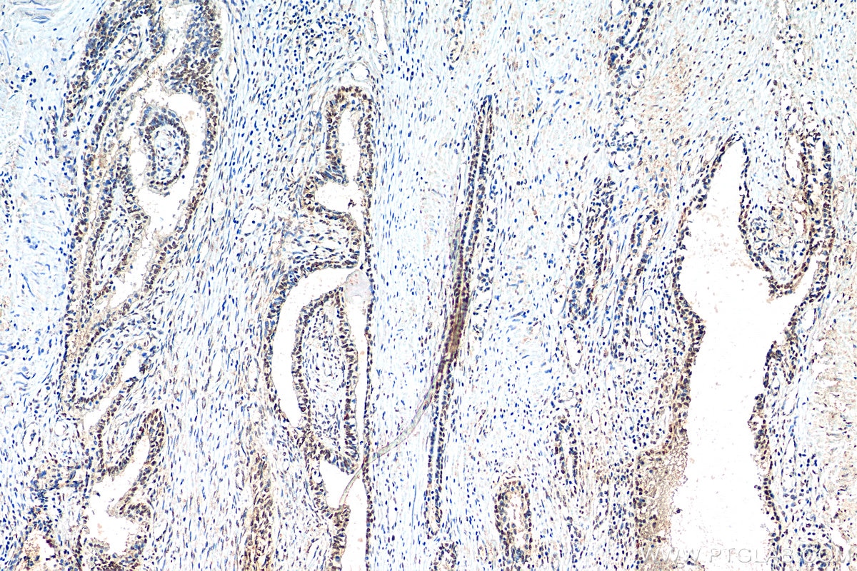 Immunohistochemistry (IHC) staining of human prostate cancer tissue using MEIS2 Polyclonal antibody (11550-1-AP)