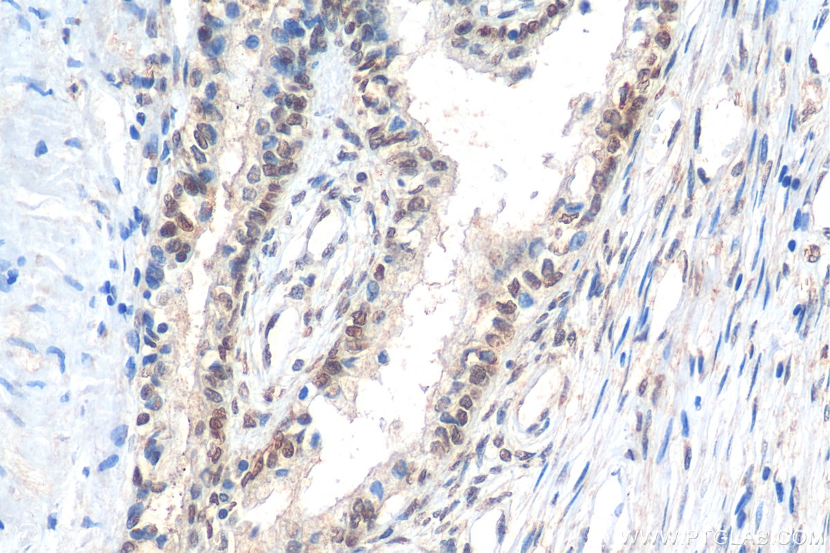 Immunohistochemistry (IHC) staining of human prostate cancer tissue using MEIS2 Polyclonal antibody (11550-1-AP)