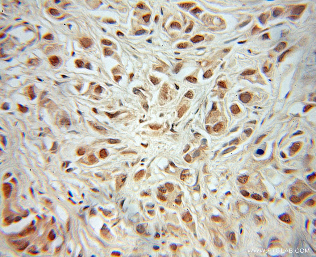 Immunohistochemistry (IHC) staining of human prostate cancer tissue using MEIS2 Polyclonal antibody (11550-1-AP)