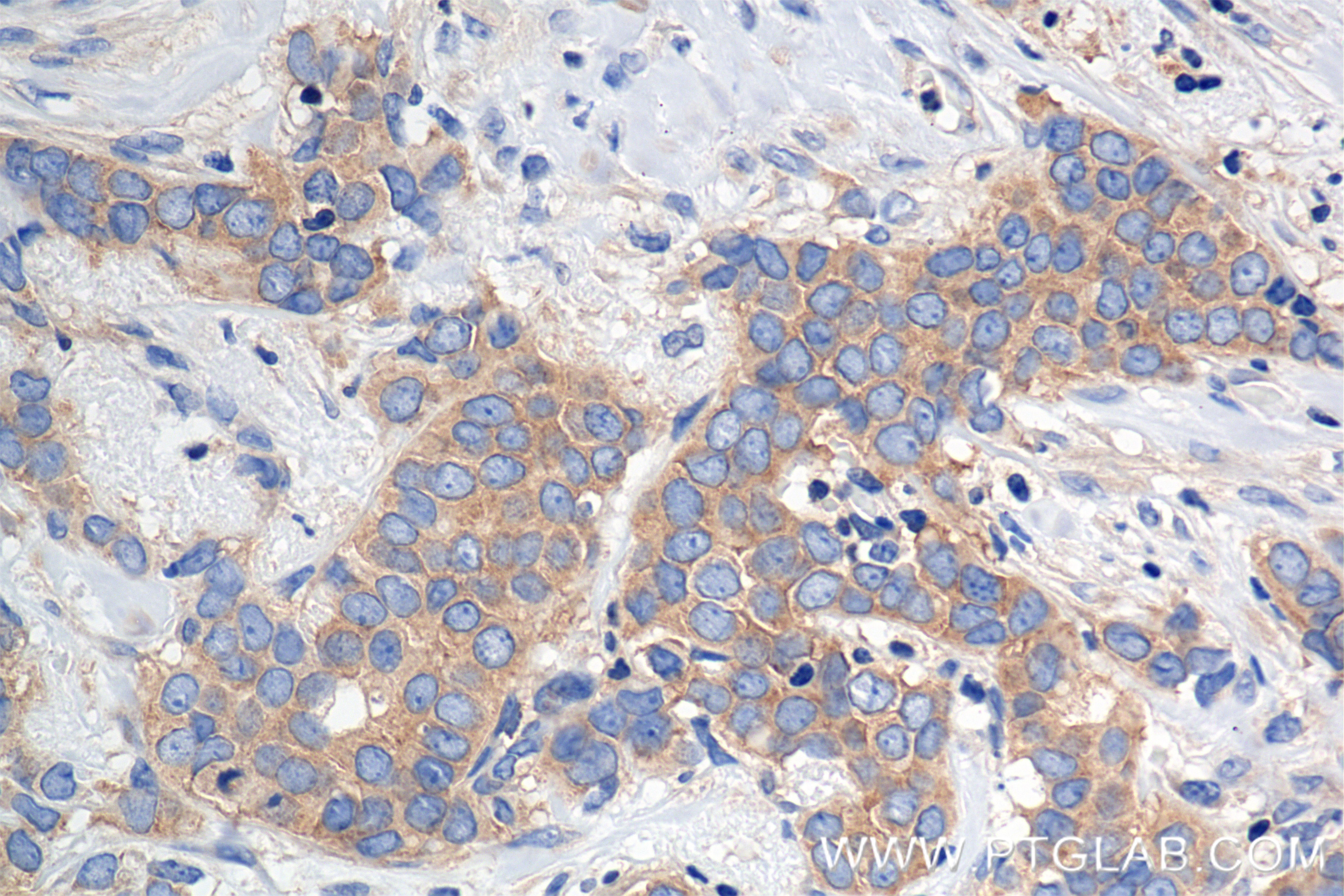 Immunohistochemistry (IHC) staining of human breast cancer tissue using MEK1/2 Recombinant antibody (84967-1-RR)