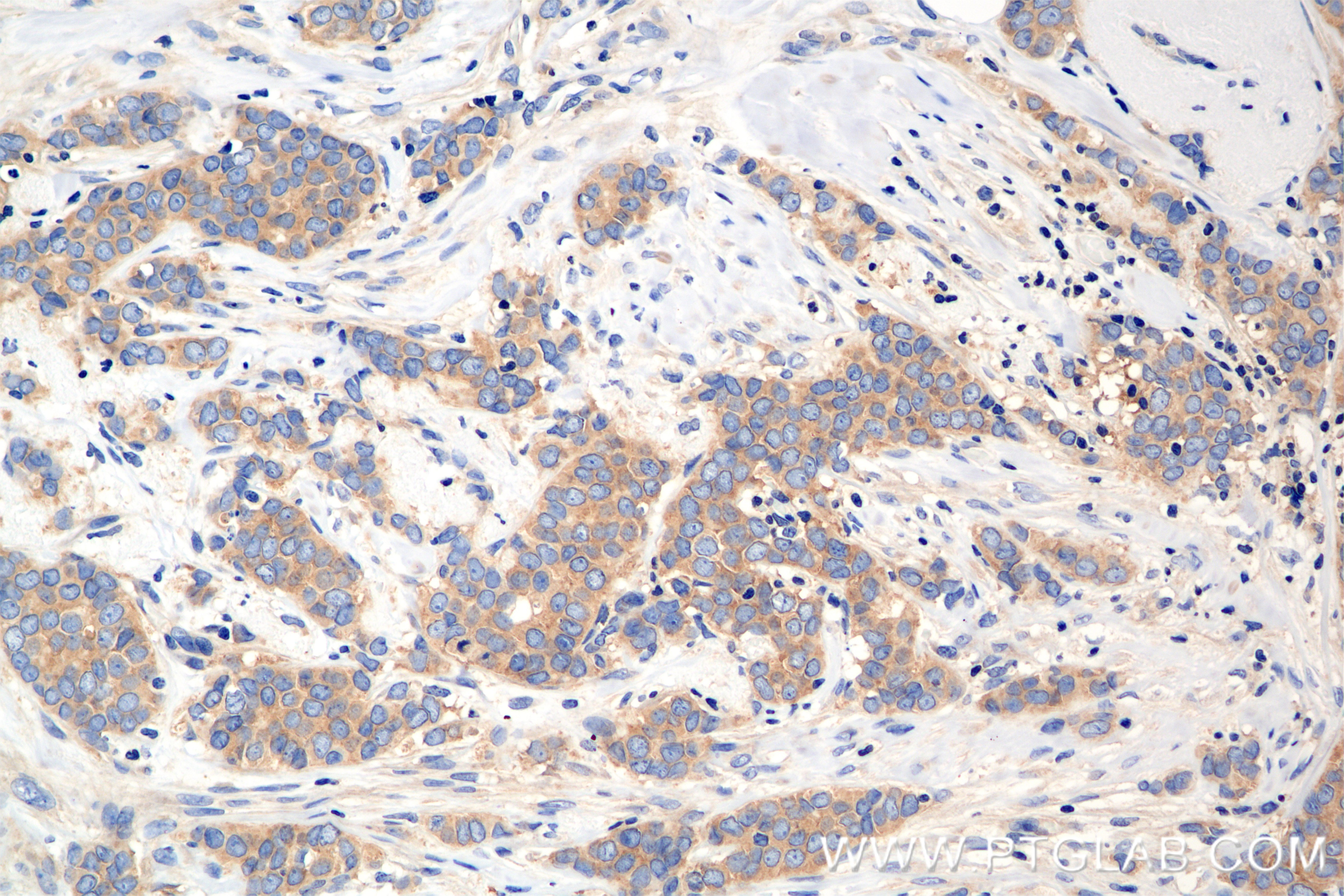 Immunohistochemistry (IHC) staining of human breast cancer tissue using MEK1/2 Recombinant antibody (84967-1-RR)
