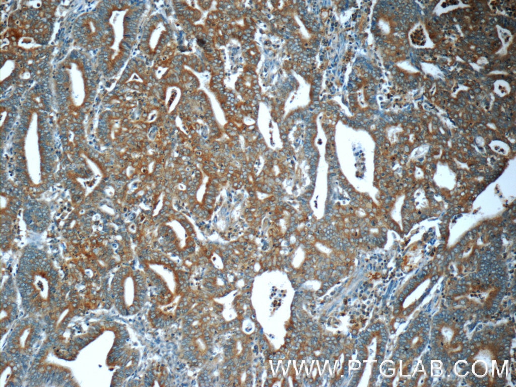 Immunohistochemistry (IHC) staining of human endometrial cancer tissue using MEK1-Specific Polyclonal antibody (51080-1-AP)