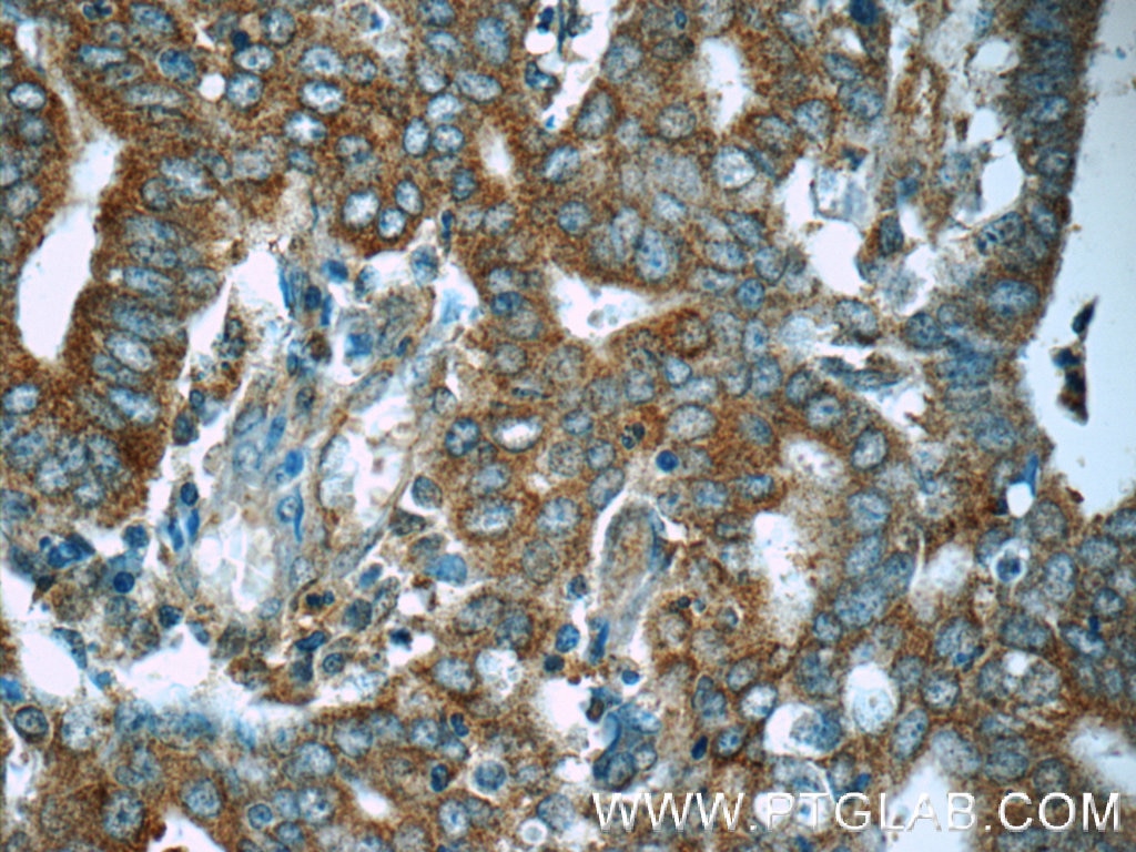 Immunohistochemistry (IHC) staining of human endometrial cancer tissue using MEK1-Specific Polyclonal antibody (51080-1-AP)