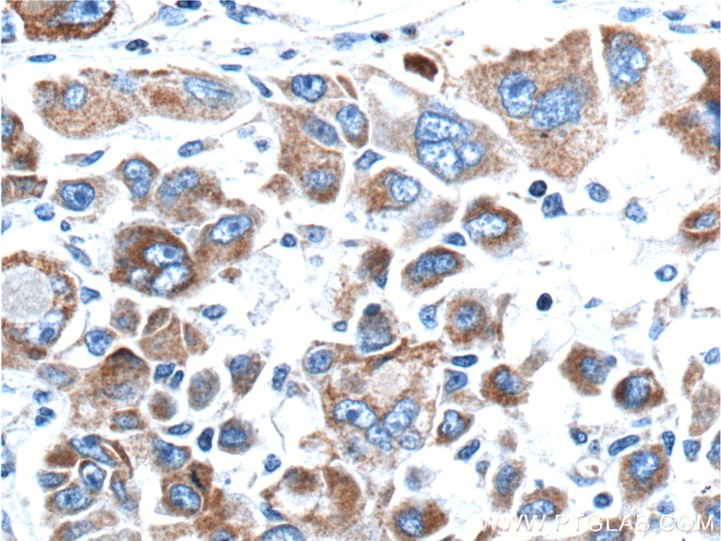 Immunohistochemistry (IHC) staining of human liver cancer tissue using MEKK3 Polyclonal antibody (21072-1-AP)