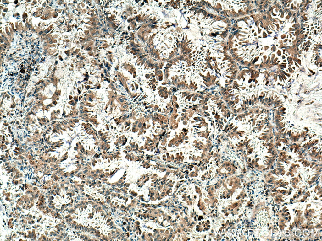Immunohistochemistry (IHC) staining of human lung cancer tissue using MELK Polyclonal antibody (11403-1-AP)