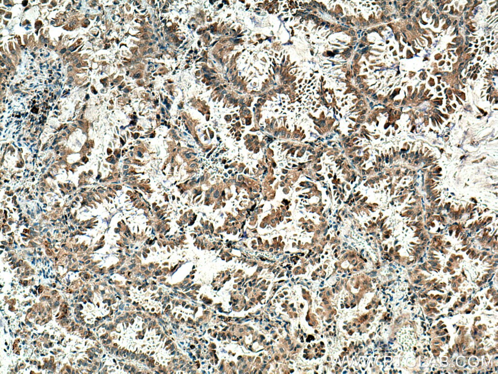 Immunohistochemistry (IHC) staining of human lung cancer tissue using MELK Polyclonal antibody (11403-1-AP)