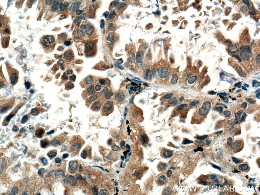 Immunohistochemistry (IHC) staining of human lung cancer tissue using MELK Polyclonal antibody (11403-1-AP)