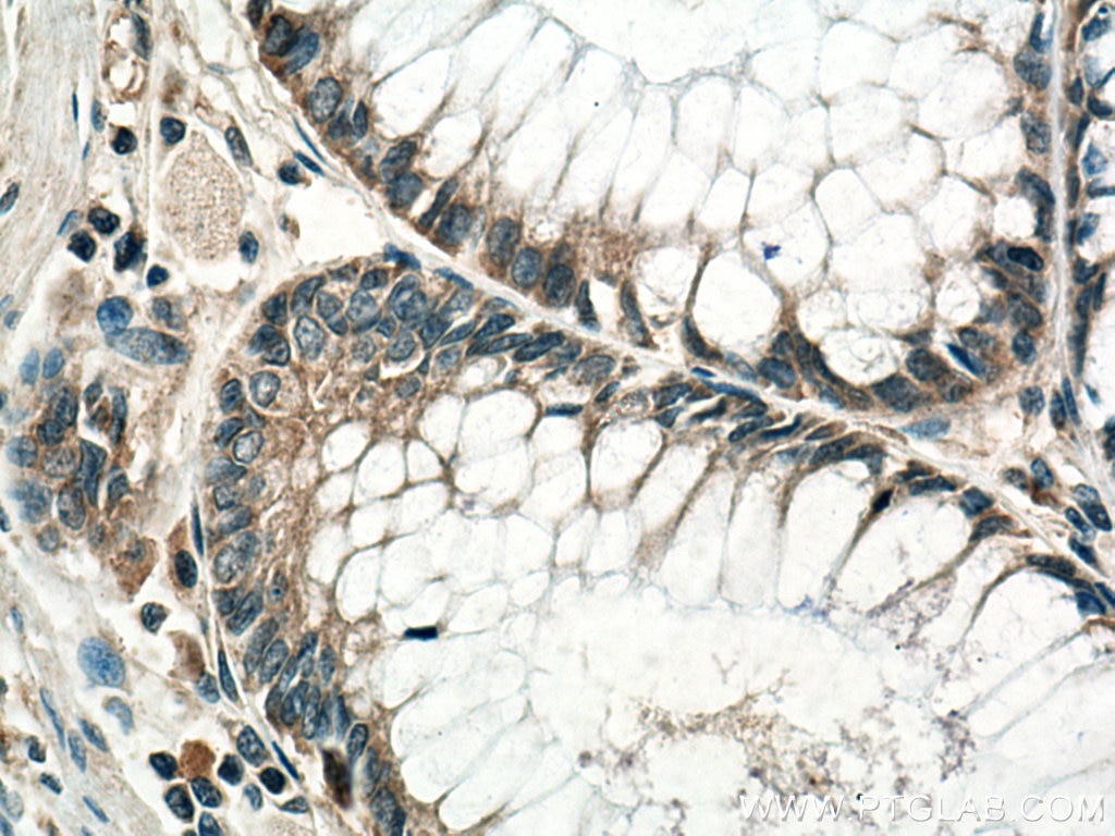 Immunohistochemistry (IHC) staining of human colon cancer tissue using MELK Polyclonal antibody (11403-1-AP)