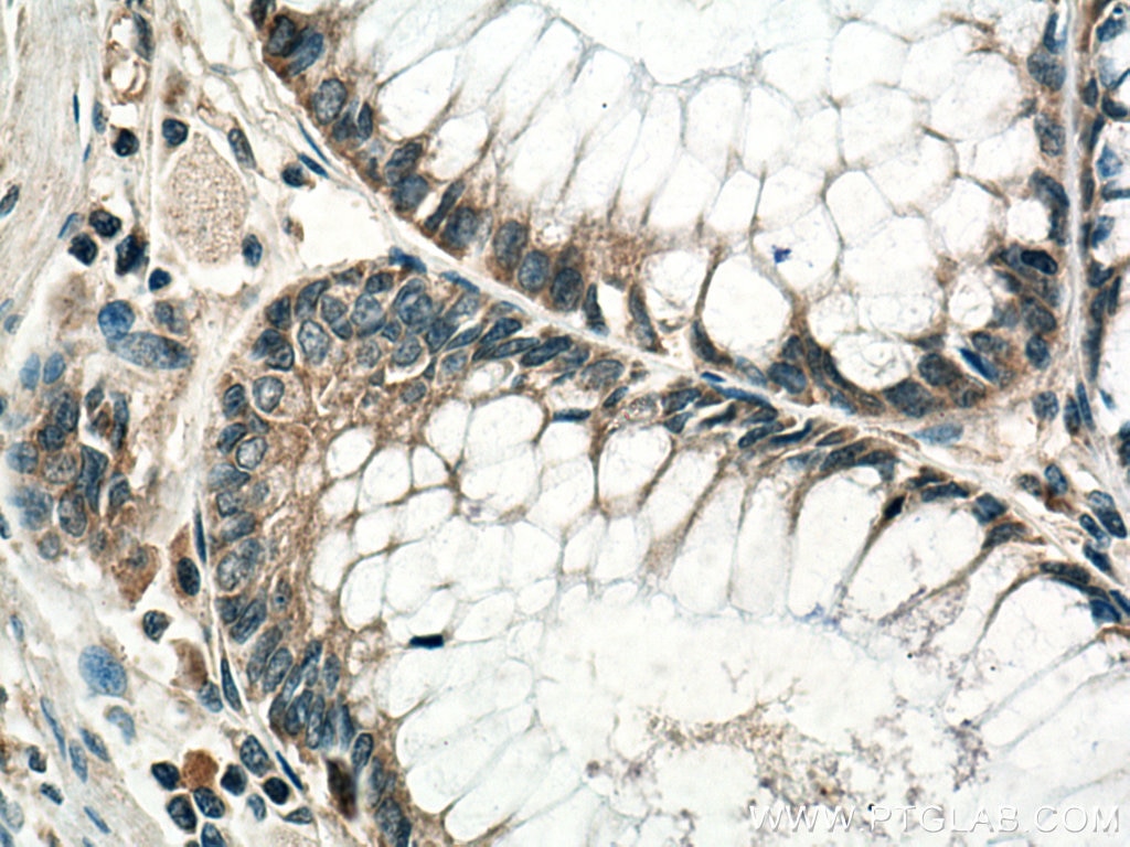 IHC staining of human colon cancer using 11403-1-AP