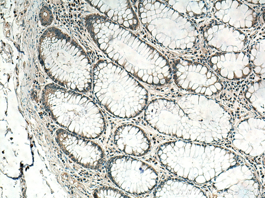 IHC staining of human colon cancer using 11403-1-AP