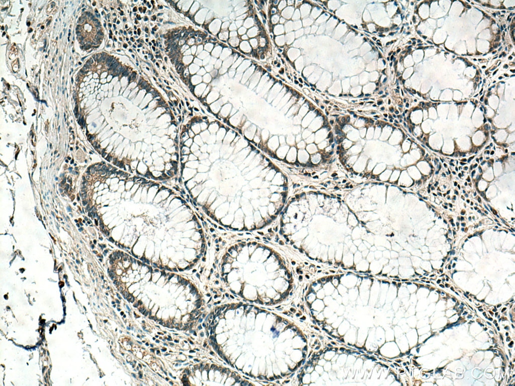 Immunohistochemistry (IHC) staining of human colon cancer tissue using MELK Polyclonal antibody (11403-1-AP)