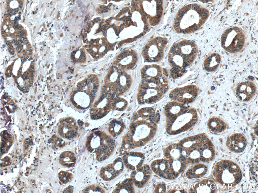 Immunohistochemistry (IHC) staining of human breast cancer tissue using MELK Polyclonal antibody (11403-1-AP)