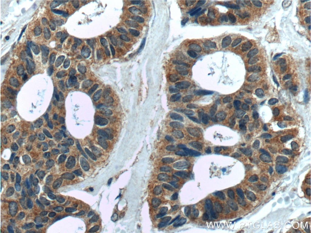 Immunohistochemistry (IHC) staining of human breast cancer tissue using MELK Polyclonal antibody (11403-1-AP)