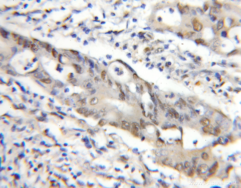 Immunohistochemistry (IHC) staining of human colon cancer tissue using MEPCE Polyclonal antibody (11526-1-AP)